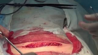 Косметический шов  Лапаротомия по Пфанненштилю Cosmetic suture Laparotomy by Pfannenstiel 美容缝合