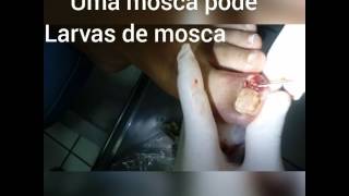 Unha infeccionada com larvas de mosca - onicocriptose com granuloma