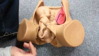 Breech delivery and ECV