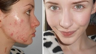Food + Drink Tips For Acne & Products I've Used For Clear Skin