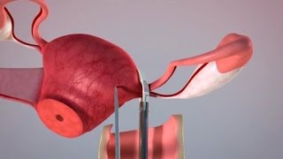 Minimally invasive vaginal hysterectomy using ligasure impact