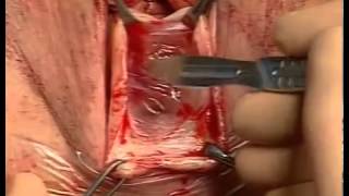 Vaginal Prolapse Prolift Total
