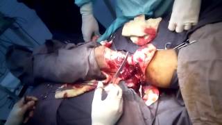 Amputation