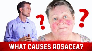 My Opinion About the Cause of Rosacea?