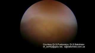 Эмбриоскопия (EMBRYOSCOPY ). Пороки развития плода 12 недель