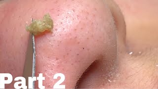 squeezing hidden acne + blackheads part 2