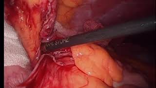Laparoscopic Appendectomy Subserosal Paracecal Appendix