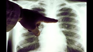 ★Этот овощной коктейль от Австрийского врача вылечил 45 000 больных РАКОМ. Диета при онкологии.