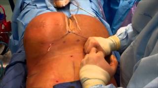 Mis gluteos después de un aumento por el Dr. Cortes