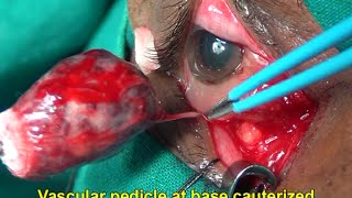 Anterior orbitotomy cavernous hemangioma Soosan Jacob 1 5 min