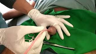 Uttara Basti for treatment of male infertility by Dr.madhav diggavi