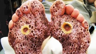 Trypophobia Skin, Feet &  Fleas Eggs