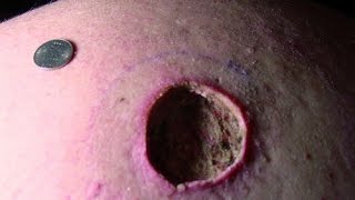 Угри,прыщи и всякое ФЕее/WoW many HUGE BLACKHEADS