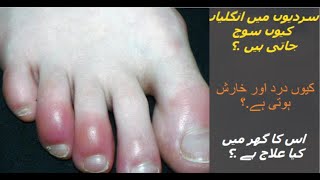 How to Treat Red, Swollen, painful toes at home.?.. !! How to Prevent and Treat Chilblains.?