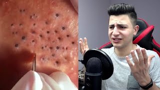 СЛАБОНЕРВНЫМ НЕ СМОТРЕТЬ! ЧЕРВЯКИ ПОД КОЖЕЙ? КАК СНИМАЮТ ЧЕРНЫЕ ТОЧКИ... РЕАКЦИЯ