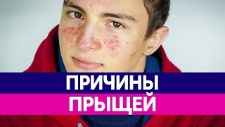 Как ИЗБАВИТЬСЯ ОТ ПРЫЩЕЙ? Причины прыщей, как убрать прыщи