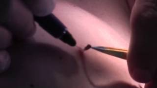 Fibroma treatment with the Viridex RF