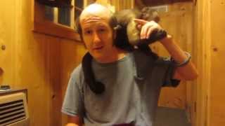 Male Pattern Baldness