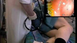 YouTube   colonoscopy