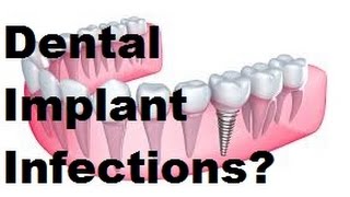Dental Implant Infections LIVE WARNING