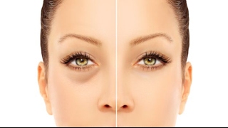 How To Remove Dark Circles Permanently? Amazing Results!!