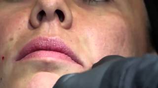 Teosyal Pen: trattamento completo - prof. G. Sito