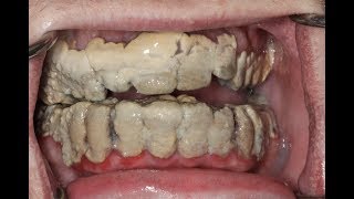 20 Years Without Brushing Teeth ? | Calculus Removal