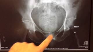 Fecal Impaction - Fecaloma