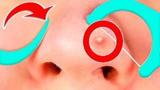 УЖАС! ПРЫЩ! 5 РАБОЧИХ ЛАЙФХАКОВ ОТ ПРЫЩЕЙ