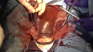 Emergency Hysterectomy Trainer