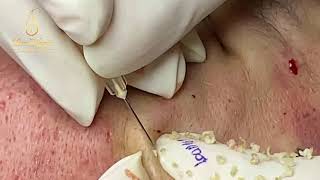 REMOVAL BLACHEADS AND WHITEHEADS (101) | Loan Nguyen