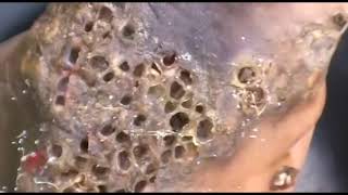 Scariest Feet Jiggers Parasites Give Eggs Cleaning Step