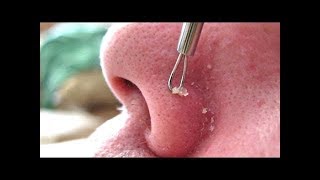 Новое выдавливание ПРЫЩЕЙ и ЧЕРНЫХ ТОЧЕК!  p26