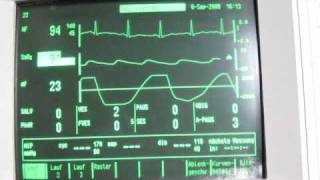breath hold EKG with oxygen desaturation