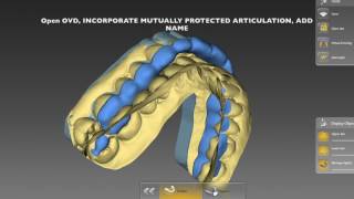 InLab 16 Splint