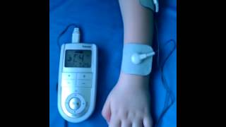 Ишемическая контрактура Фолькмана. Volkmann`s ischemic contracture 2(6). Электронейромиостимуляция.