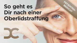 Schlupflider entfernen: "Ich kann es nur jedem empfehlen." Erfahrungsbericht nach Oberlidstraffung