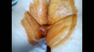 Giant Papilloma!!! Огромная папиллома!!!