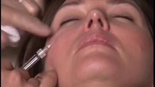 Treatment with Revanesse Ultra: Nasolabial Folds, Marionette Lines and Submalar Area