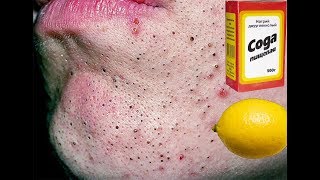 ★Лимон и сода от ЧЕРНЫХ ТОЧЕК. Эта смесь очистит кожу и раскроет поры.