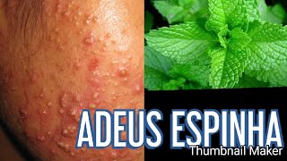 COMO TIRAR ESPINHA/ ACNE COM 2 APLICAÇÃO COM HORTELÃ