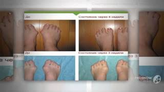valgus pro отзывы

  - Фиксатор Valgus Plus