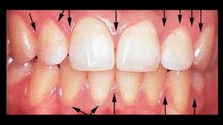 Can Receding Gums Grow Back