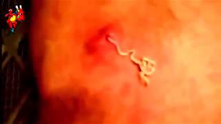 Шок!!! Подборка 2017г огромных прыщей и чиряков гнойников Popping Pimples 2017