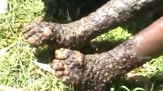 Andrew's Jigger Treatment, Part One Parasitic Fleas Removed in Remote Kenya