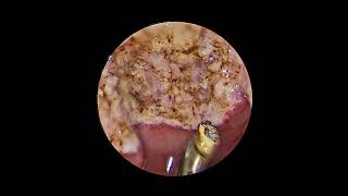coblator assisted adenoidectomy