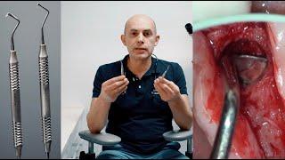 Микро-хирургические кюреты для синус-лифтинга