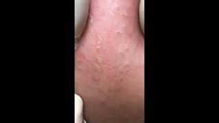 Hidden acne caused by cosmetics 06/26/2019