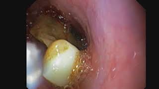 Foreign body removal from esophagus (artificial denture ).