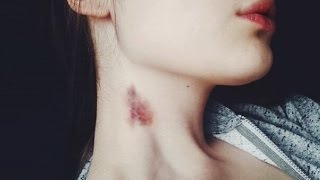 КАК БЫСТРО Избавиться от ЗАСОСА/СИНЯКА?✔Elena Matveeva